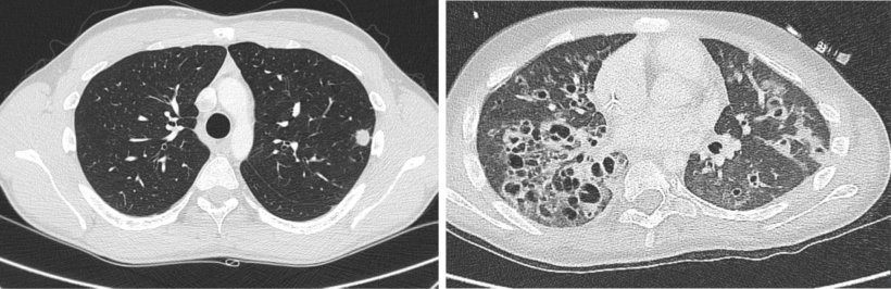 The parasites themselves mostly remain invisible in the CT scan. However, the...