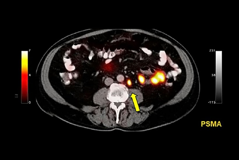 This prostate-specific membrane antigen (PSMA) scan shows a recurrence of...