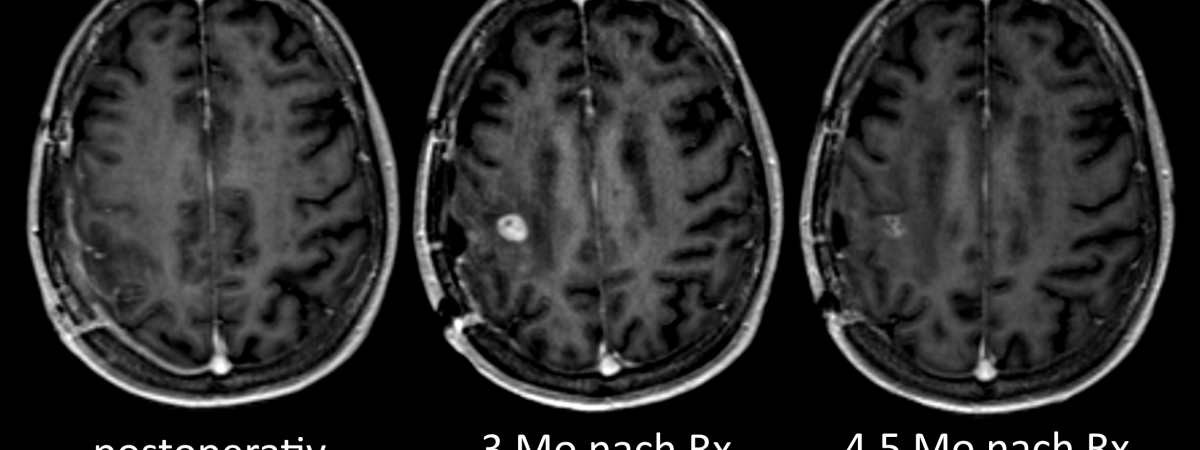 Therapieassoziierte Phanomene Erschweren Diagnostik