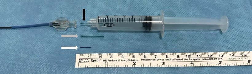 Embolization fragment suture placed in a 5-mL syringe before release (Black...
