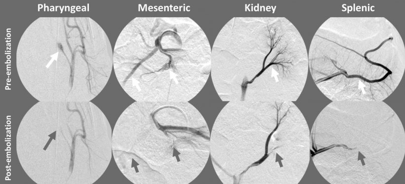 Arteriography of different vascular targets before (white arrow) and after...