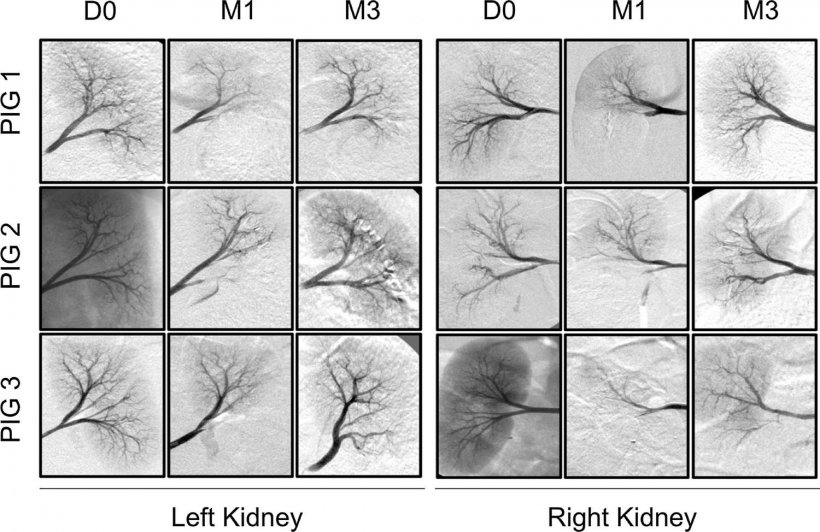 Lower left renal lobar artery embolization with absorbable sutures (AS). Lower...