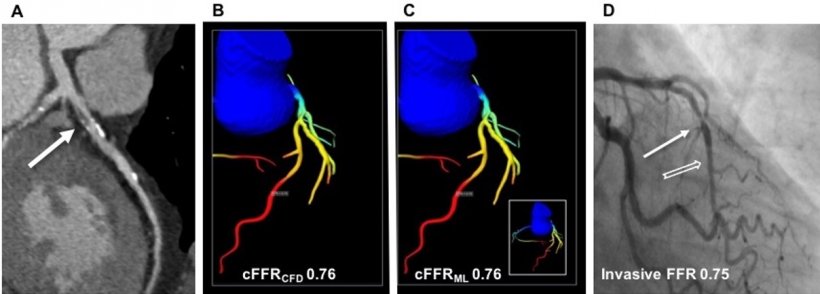 Example of coronary stenosis on cCTA (A) and ICA with corresponding CT-FFR (B,...