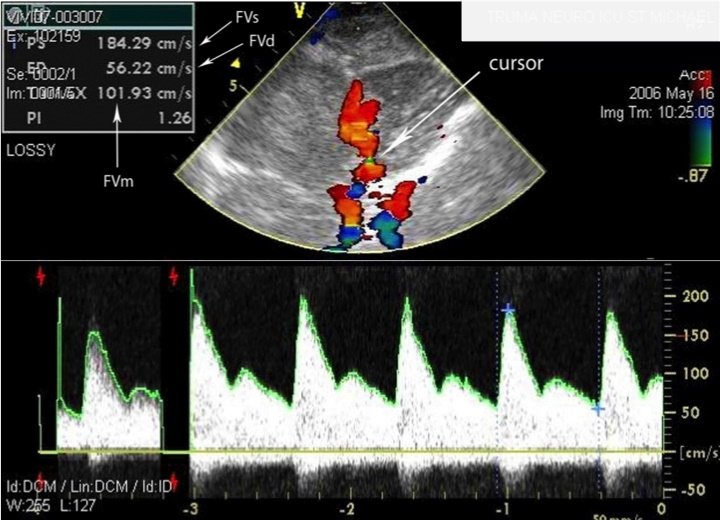 Non-invasive ICP can be estimated through waveform analysis of the main...