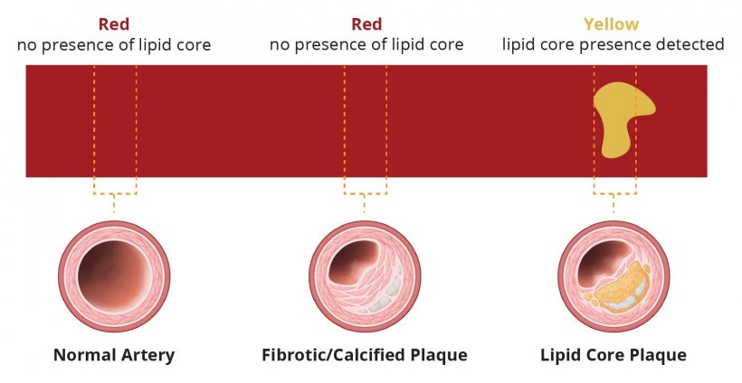 Lipid Core Burden Index (LCBI)