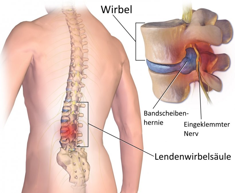 schematic of herniated disc