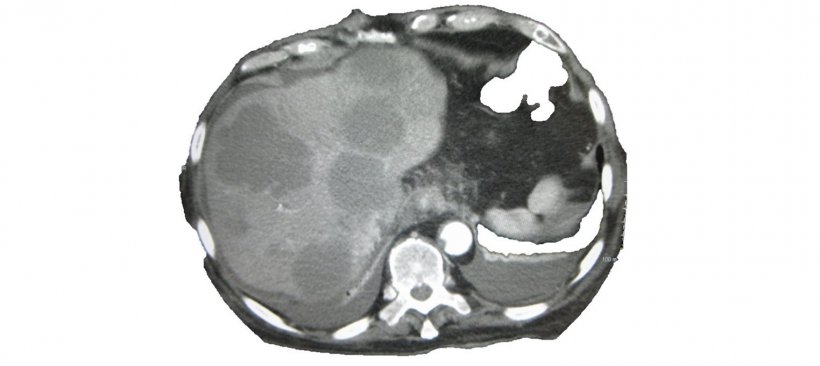 liver metastasis