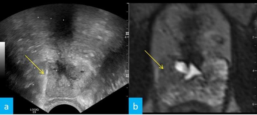 Abb. 2: Ultraschallgeführte Fusionsbiopsie (Pfeil in a) des MRT-Herdbefundes...