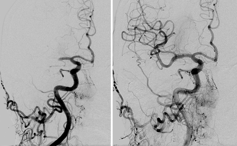 Patient vor Thrombektomie mit Verschluss des M1-Segmentes der A. cerebri media...
