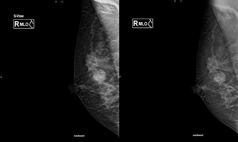 Abbildung links: Synthetisches 2D-Mammographie-Bild einer 39-jährigen...