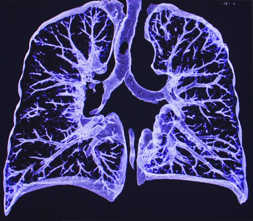 Lungenscreening – weil wir uns kein Lungenscreening nicht leisten können