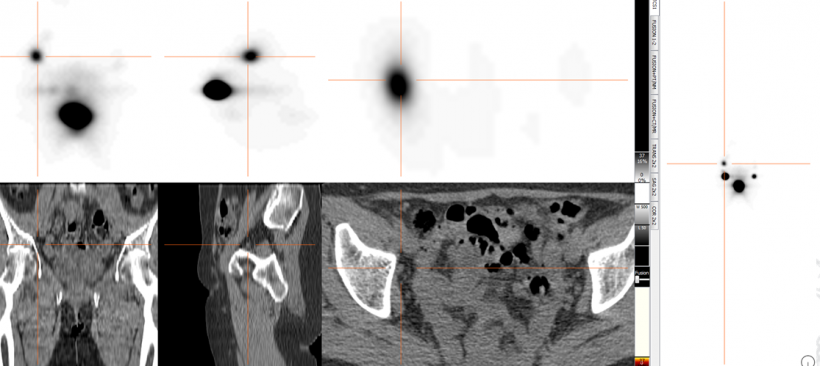 Beispiel aus der Lymphknoten-Diagnostik: das planare szintigraphische Bild mit...