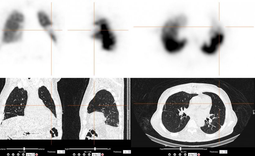 Lungenemboliediagnostik: SPECT/CT mit segmentaler Lungenembolie im linken...