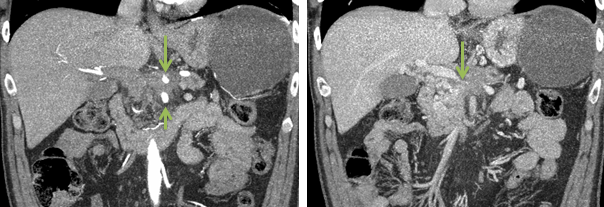 Mehrphasen-CT zum Staging eines Pankreaskarzinoms. Coronale Reformatierung in...
