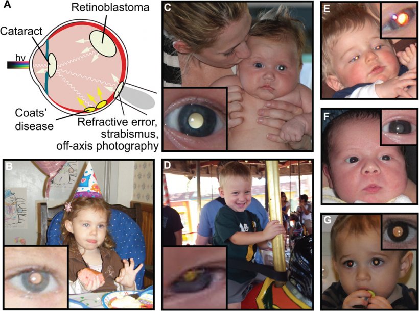 Examples of pathologic and physiologic leukocoria detected in childhood...