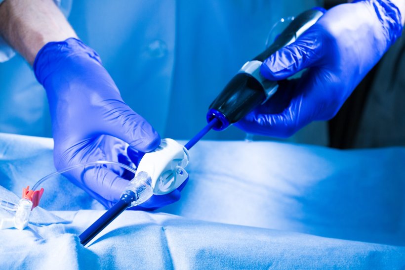 person with blue medical gloves preparing catheter insertion
