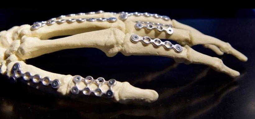model of human hand skeleton with metal implants