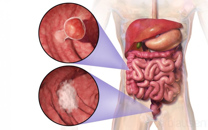 schematic of human colorectal cancer