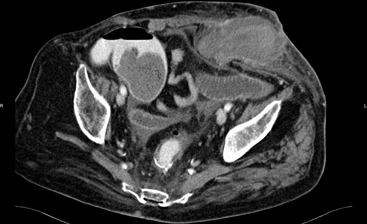 Kontrastgestützte Abdomen CT mit Nachweis einer inkarzerierten Narbenhernie...
