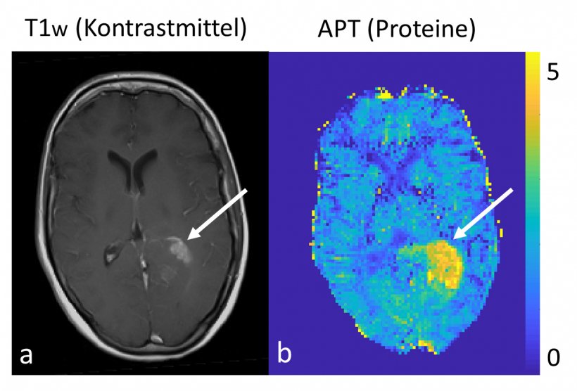 Left: conventional morphological contrast-enhanced image of a brain tumour at 3...