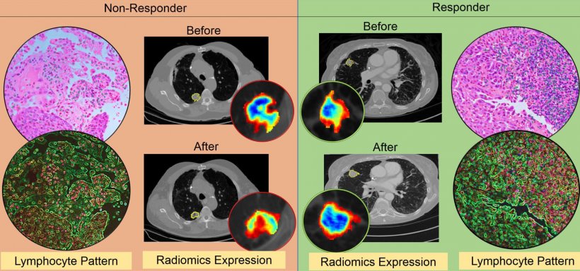 An illustration of the differences in CT radiomic patterns before and after...