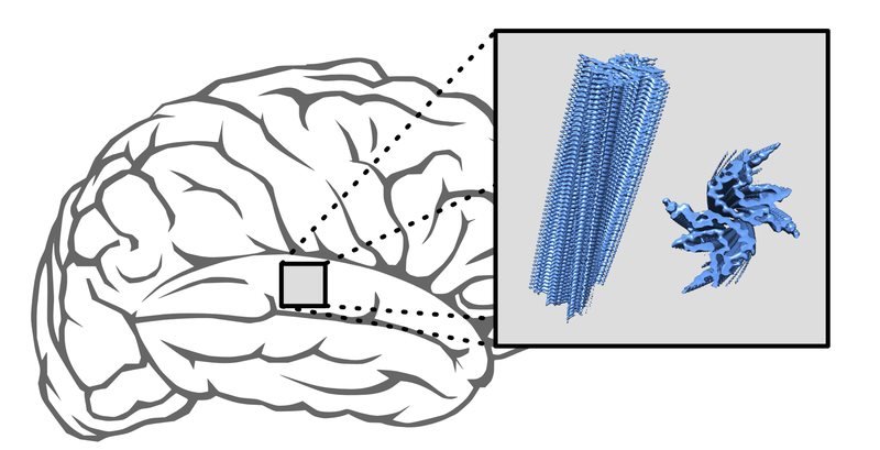 In Parkinson’s and multisystem atrophy, proteins accumulate in layers to form...