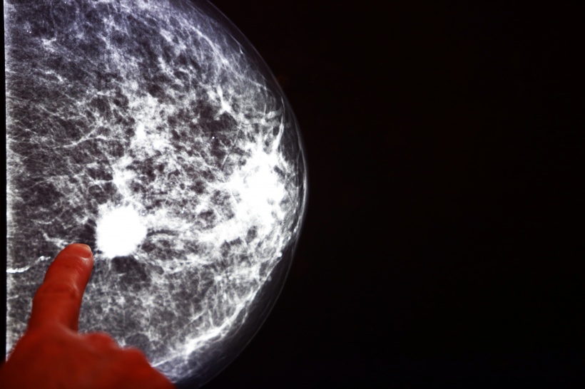 X-ray mammogram image of breast with cancer