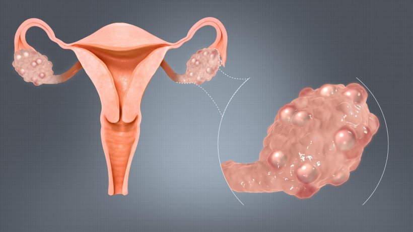 Better treatment for women with PCOS