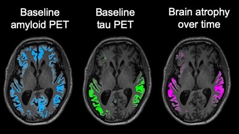 Tau PET brain scans (green) in early clinical-stage Alzheimer’s patients...