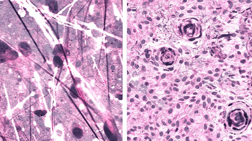 Stimulated Raman histologic images of diffuse astrocytoma (left) and meningioma...