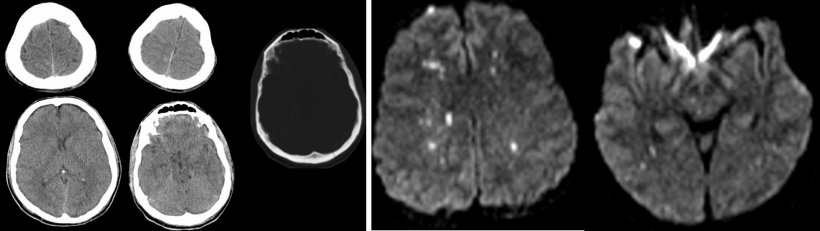 Diffuses axonales Trauma: Die CT zeigt nur eine geringe Subarachnoidalblutung...