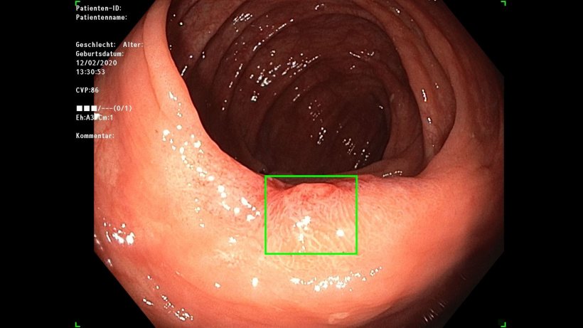 endoscopy image with green rectangle marking of suspect area