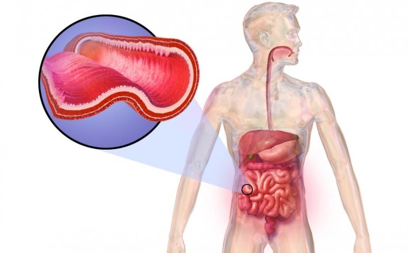 schematic of crohns disease