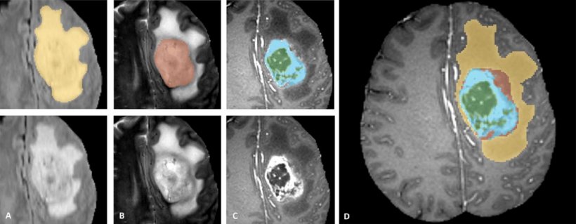 Typical segmentation of a tumoural lesion in the left frontal region as...