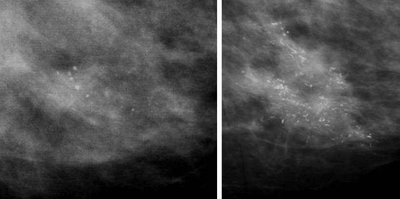 breast calcification