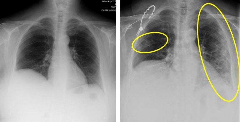 thorax xray images