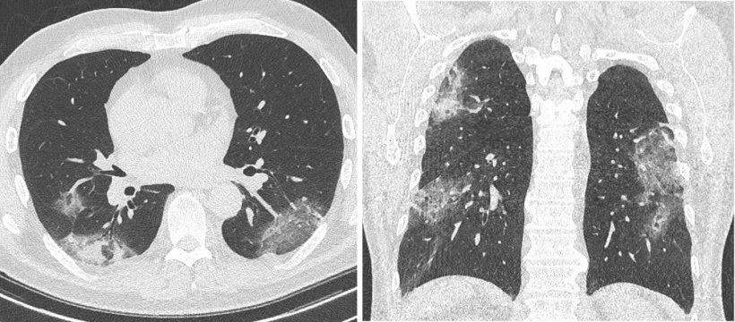 Computed tomography of a patient with RT-PCR confirmed SARS-CoV 2 infection...