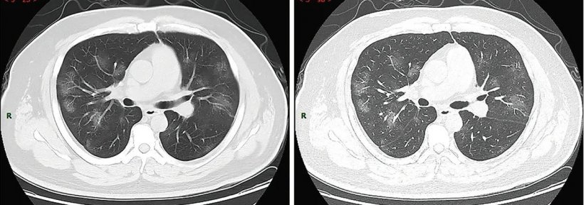 COVID-19 CT chest