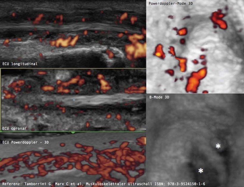 Tenosynovitis der ECU Sehne bei Rheumatoider Arthritis (links) und aktive...