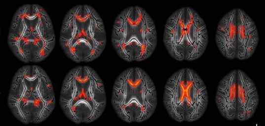 MRI image of a brain