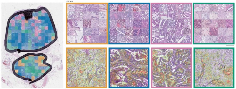 Image-based consensus molecular subtype classification (imCMS) and...