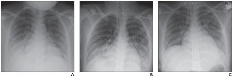 How lung disorders like COVID 19 affect children healthcare in