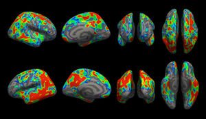 Gehirn im Scan: Farbe zeigt den Verlust von Synapsen