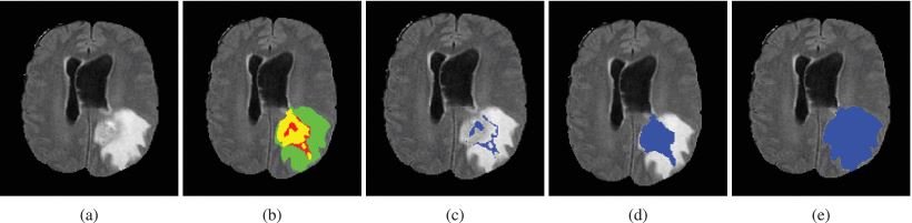 MRI scan slice of FLAIR modality along with its respective GT for subject id...
