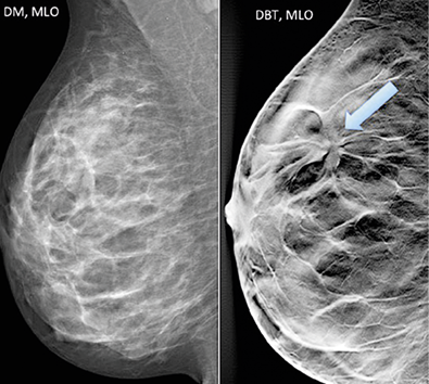 DM v. DBT imaging