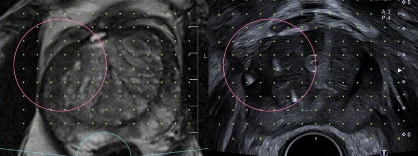 Grid Überlagerung im MRT und US Bild zur Nadelplatzierung um den Tumor. Exakte...