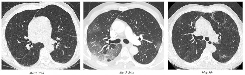 Good evolution of a COVID-19, with almost normal initial chest CT at day D3,...