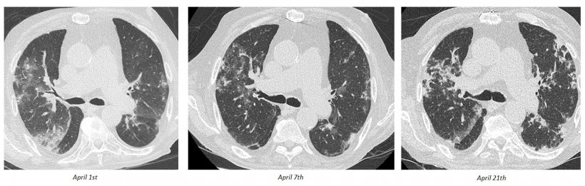 Moderate GGO and alveolar consolidations on initial Chest CT at D7, evolving...