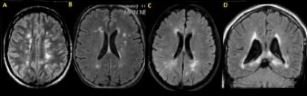 Figure 1: Differential diagnosis of MS; from left: fat embolism, Lyme disease,...