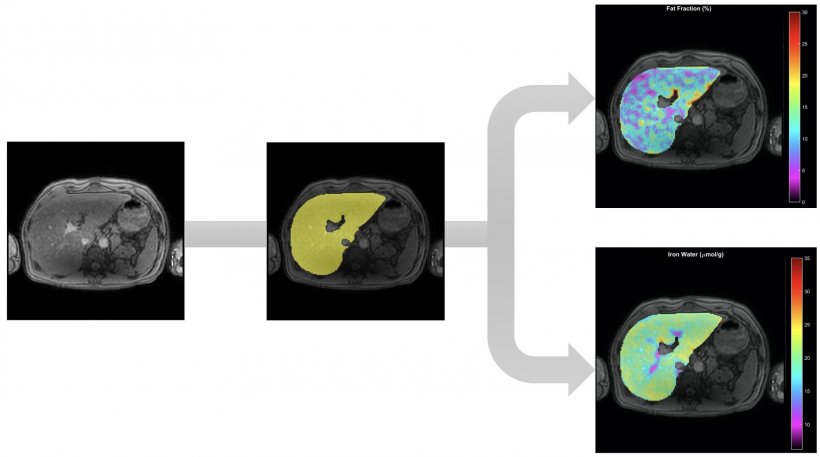 Liver segmentation (flow quantification)